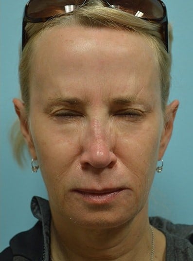 After Image: Botox - front