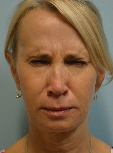 Before Image: Botox - front