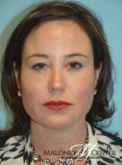 After Image: Botox - front