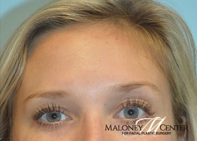 After Image: Botox - front