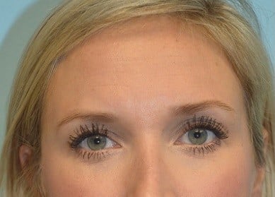 Before Image: Botox - front