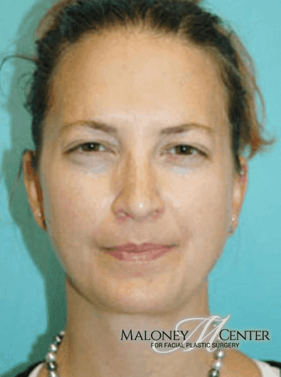 After Image: Botox - front