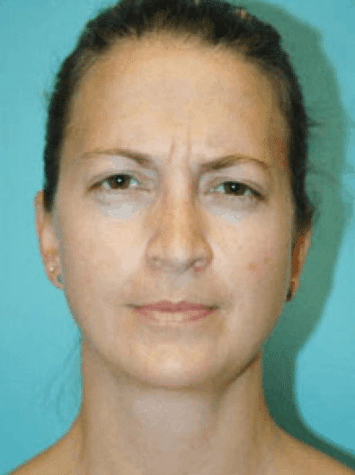 Before Image: Botox - front