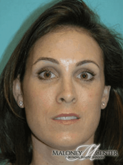 After Image: Botox - front