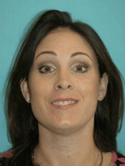 Before Image: Botox - front