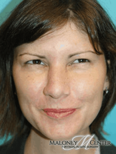 After Image: Botox - front
