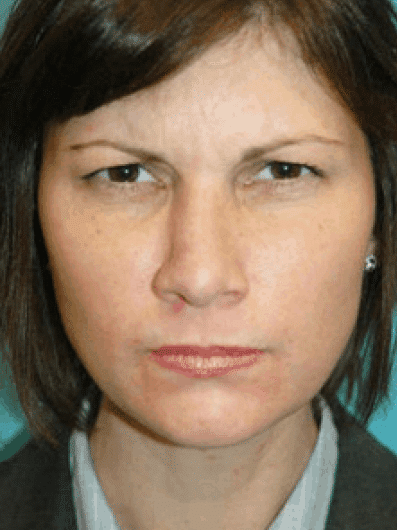 Before Image: Botox - front