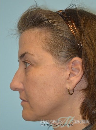 After Image: Botox - left-side