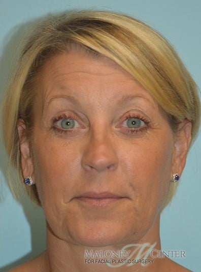 After Image: Botox - front