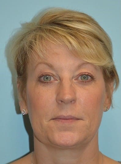 Before Image: Botox - front