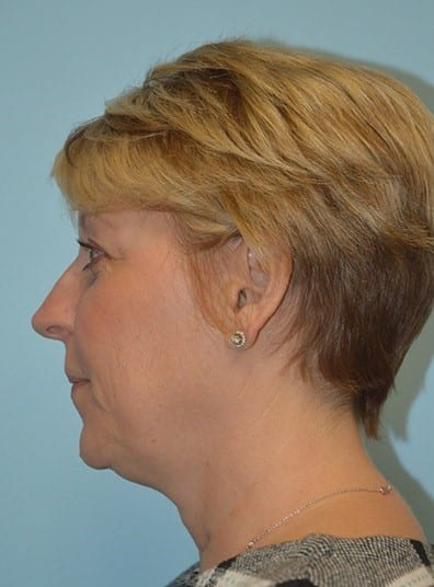 Before Image: Botox - left-side