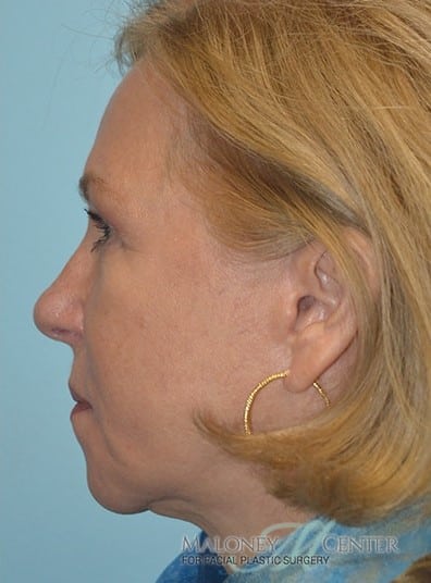 After Image: Botox - left-side