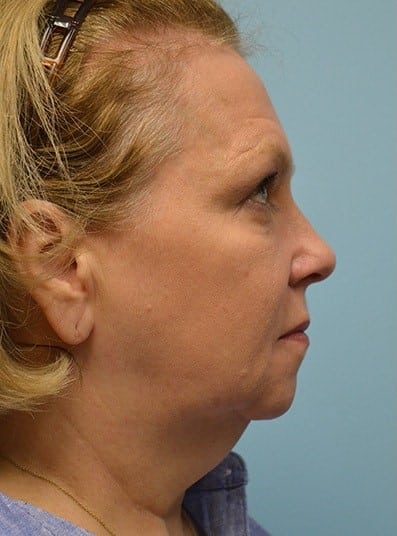 Before Image: Botox - right-side