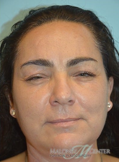 After Image: Botox - front