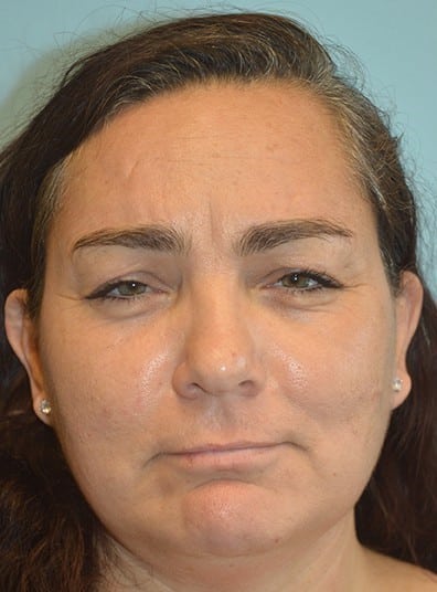 Before Image: Botox - front