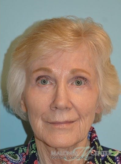 After Image: Botox - front