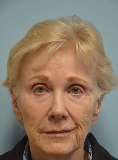 Before Image: Botox - front
