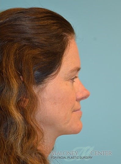 After Image: Botox - right-side