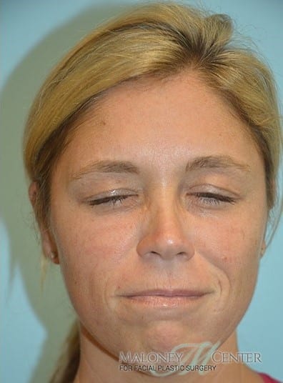 After Image: Botox - front
