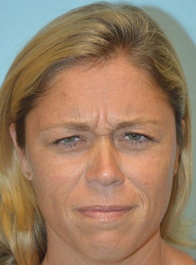 Before Image: Botox - front