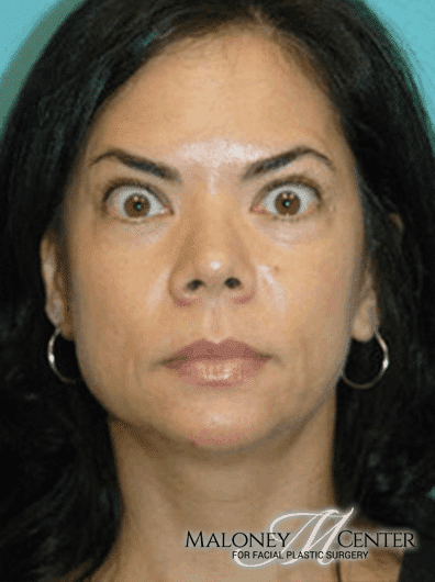 After Image: Botox - front
