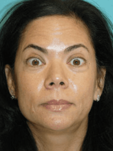 Before Image: Botox - front