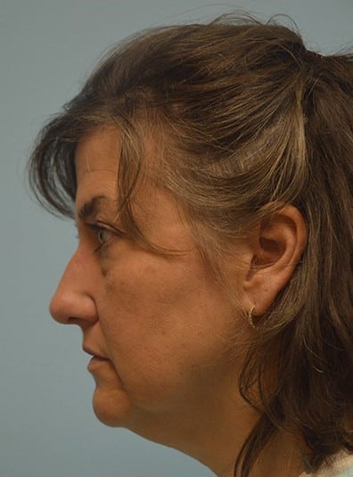 Before Image: Brow Lift - left-side