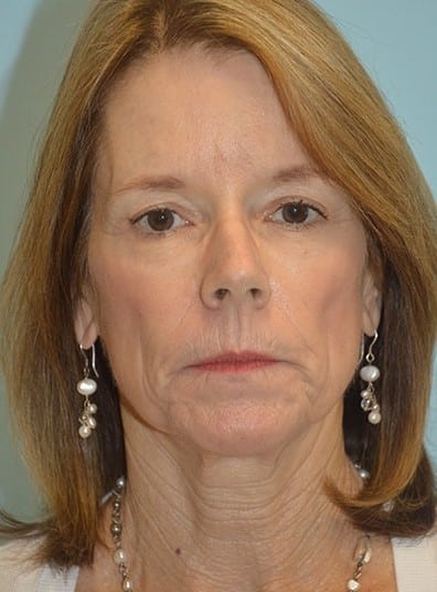 After Image: Brow Lift - front