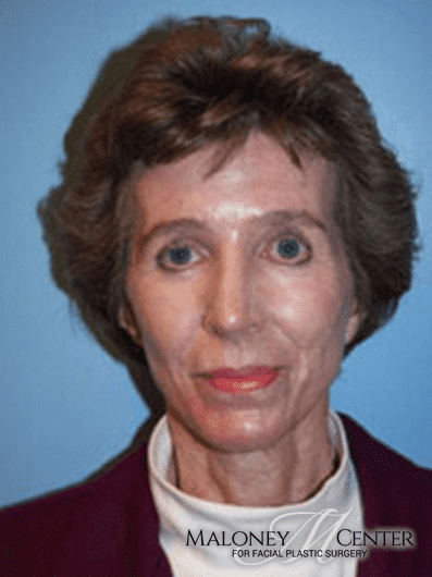 After Image: Brow Lift - front