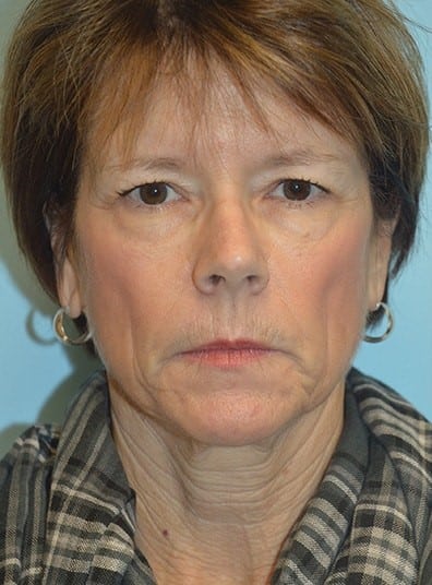 Before Image: Brow Lift - front