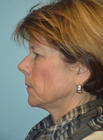 Before Image: Brow Lift - left-side
