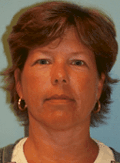 Before Image: Brow Lift - front