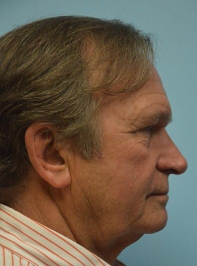 Before Image: Brow Lift - right-side