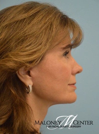 After Image: Brow Lift - right-side