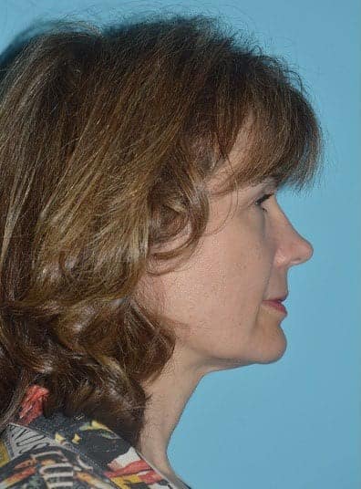 Before Image: Brow Lift - right-side