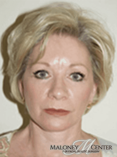 After Image: Brow Lift - front