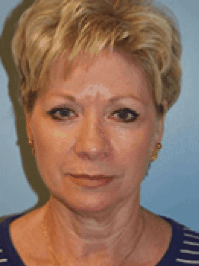 Before Image: Brow Lift - front