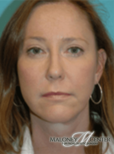 After Image: Brow Lift - front