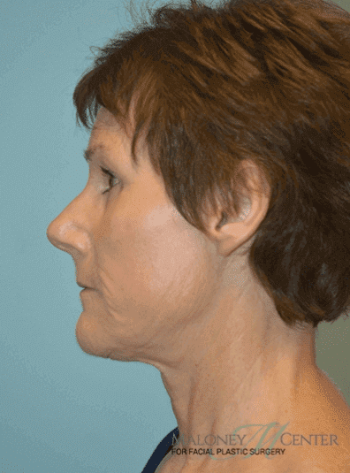 After Image: Brow Lift - left-side
