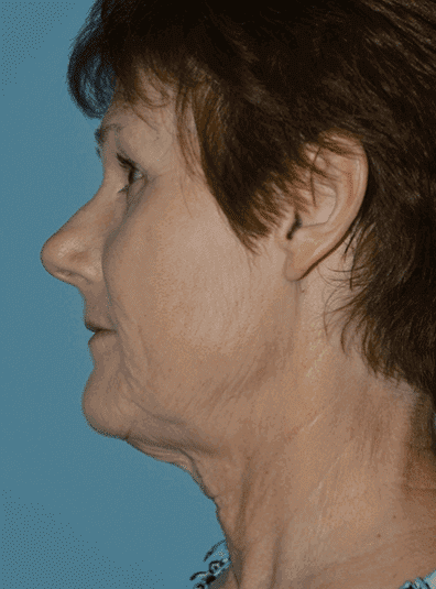 Before Image: Brow Lift - left-side