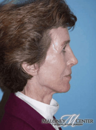 After Image: Brow Lift - right-side