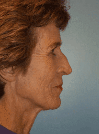 Before Image: Brow Lift - right-side