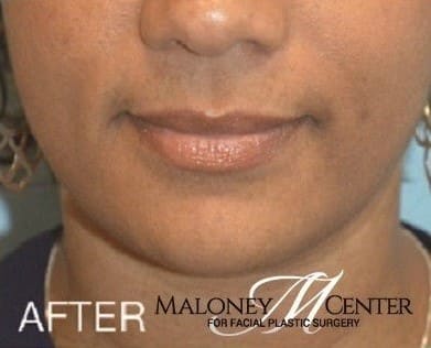 After Image: Kybella Double Chin Facial Fat Removal - front