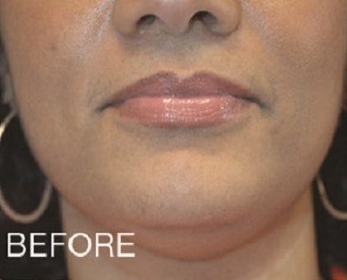 Before Image: Kybella Double Chin Facial Fat Removal - front