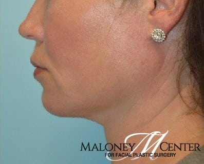 After Image: Kybella Double Chin Facial Fat Removal - left-side