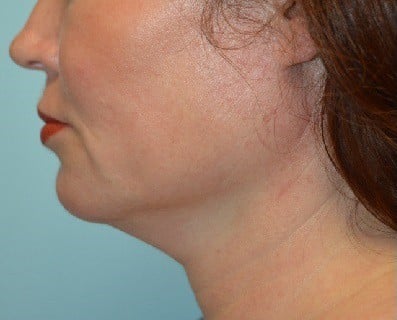 Before Image: Kybella Double Chin Facial Fat Removal - left-side