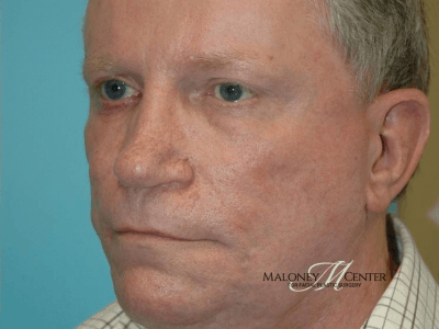 After Image: Acne Treatment - left-front-oblique