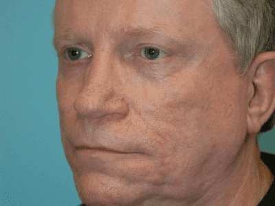 Before Image: Acne Treatment - left-front-oblique