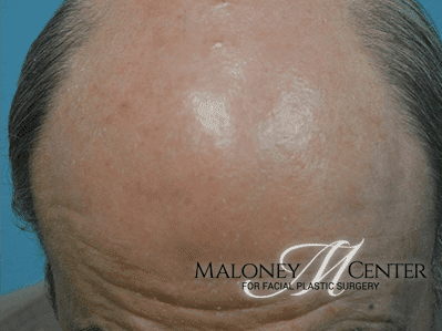 After Image: Chemical Peels - front