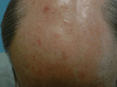 Before Image: Chemical Peels - front